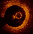 OCT/IVUS